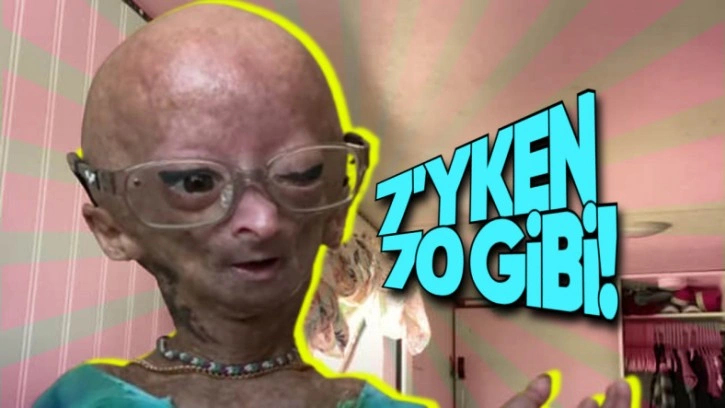 Çocukken Yaşlı Görünmeye Sebep Olan İlginç Sendrom: Progeria