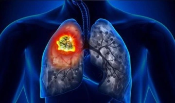 Akciğer kanseri bazen tesadüfen tespit edilebiliyor