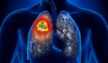 Akciğer kanseri yılda 1.8  milyon ölüme neden oluyor