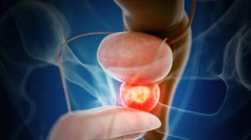 Araştırma: Prostat Kanseri Vakaları 2 Kat Artabilir!