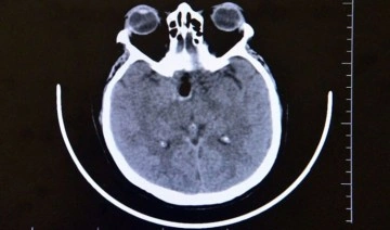 Beyinde milyonda bir görülen tümör: Ameliyatla burnundan çıkarıldı