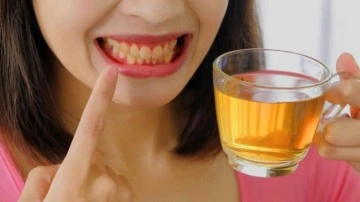 Çay yüzünden sararan dişlere çözüm: Diş lekeleri nasıl geçer, çay ve kahve dişlere zararlı mı?