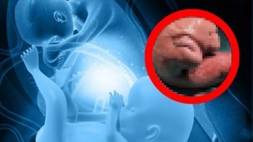 Çin'de Bir Bebeğin Beyninden İkizi Çıkarıldı!