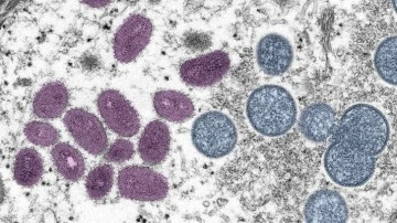 Covid, maymun çiçeği ve HIV: İtalya'da ilk kez bir kişide üç virüs birden tespit edildi