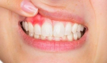 Diş iltihabı kurutulmazsa ölüme neden olabilir