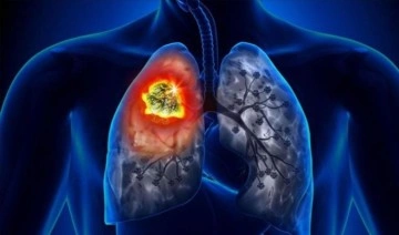 Dr. Yavuzyılmaz: 'Sigarayı bırakmak akciğer yakalanma riskini azaltıyor'
