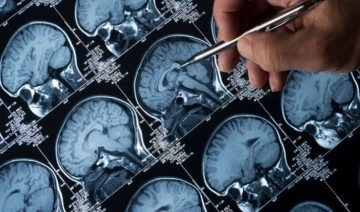 Epilepsi hastalarına yapılan müdahale 'hayati' sonuçlar doğuruyor