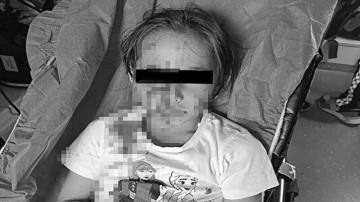 Esenyurt'ta başıboş köpek 6 yaşındaki kızın yüzünü parçaladı!