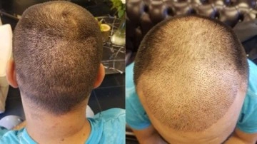Geçtiğimiz yıl 1 milyon kişi Türkiye'ye saç ektirmeye geldi