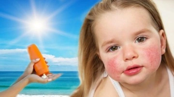 Güneş alerjisine ne iyi gelir, nasıl geçer? Güneş alerjisi belirtileri…