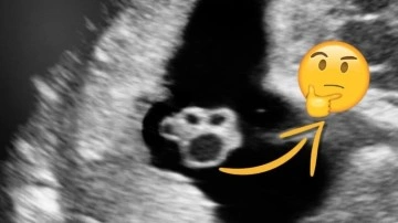 Hamile Kadınların Ultrason Görüntüsündeki Bu Şekil Nedir?