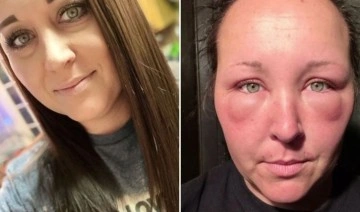Kadın, saç boyasını kullandıktan sonra alerjik reaksiyon geçirdi