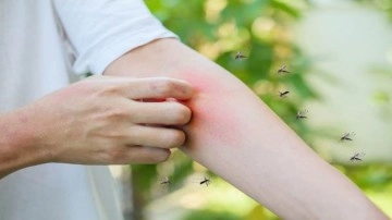 Kahrolası sivrisineklerle başınız dertte mi? Bu yöntemler sivrisinek ısırığına çok iyi geliyor