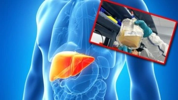 Karaciğer Yetmezliğini Bitirebilecek Lenf Bezi Tedavisi