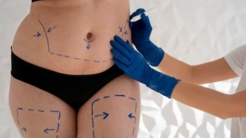 "Liposuction" hakkında doğru bilinen yanlışlar