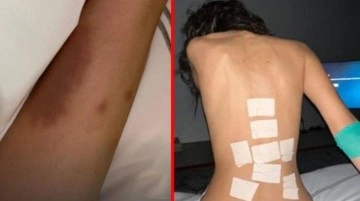Lyme hastalığıyla mücadele eden Bella Hadid, moraran vücudunu paylaştı
