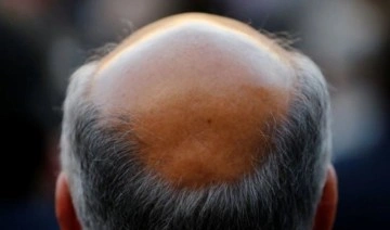 Saçı olmayanlara müjde: Bu bant dökülen saçları geri çıkarıyor