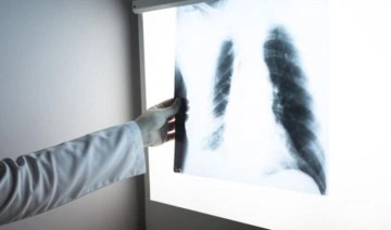 Tedavi edilmeyen her 3 akciğer embolisinden biri ölümle sonuçlanıyor