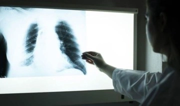 Türkiye’de bulaşıcı hastalık kaynaklı ölümlerde tüberküloz ikinci sırada