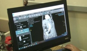 Tuzla'da aort damarında 9 santim genişleme olan hastanın böbreği yer değiştirilerek kurtarıldı