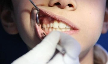 Uzmanı açıkladı: Diş sağlığını bozan alışkanlıklar...