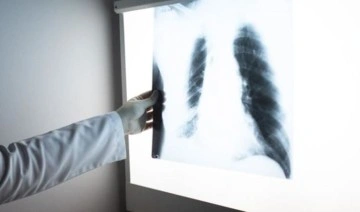 Uzmanı uyardı: Akciğer kanserinde erken tanı ile tedavideki başarı oranı artıyor