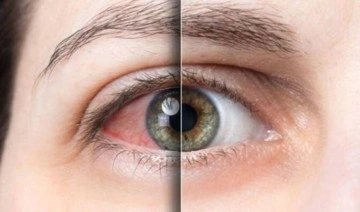 Uzmanı uyardı: ‘Sürekli göz kaşımak keratokonus hastalığına yol açabilir’