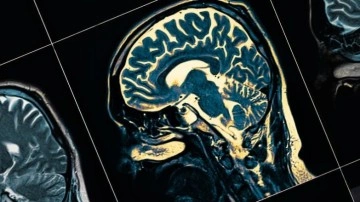 Yapay Zeka %90'lık Doğruluk Payıyla Alzheimer'ı Teşhis Etti