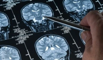 Yapay zeka Alzheimer'ı yüzde 90 oranında tespit edebildi