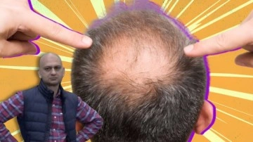 "Yer Çekimi", Saç Dökülmesinin Nasıl Bir Nedeni Olabiliyor?